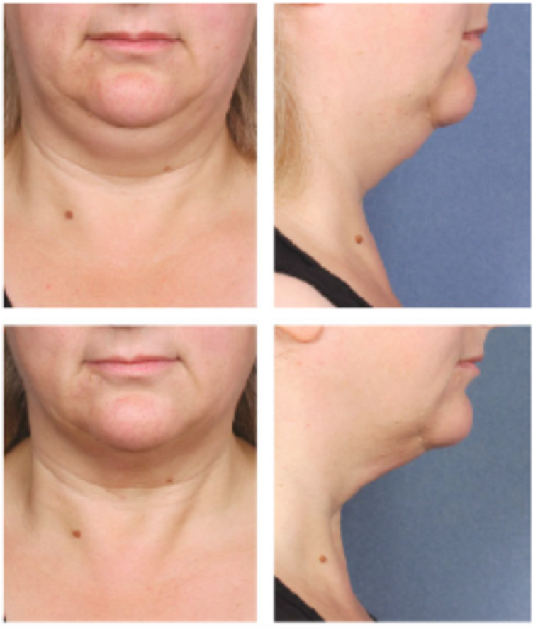 Tratamiento de la papada con Belkyra® sin cirugía 28 Papada Belkyra Openderma Before after
