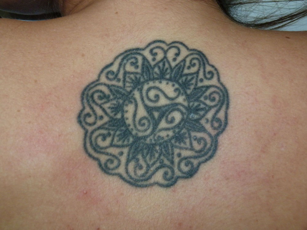 Nuevo láser para tatuajes y manchas 24 Tatuaje openderma murcia