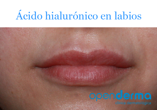 Ácido hialurónico en labios 12 acido hialuronico labios openderma murcia