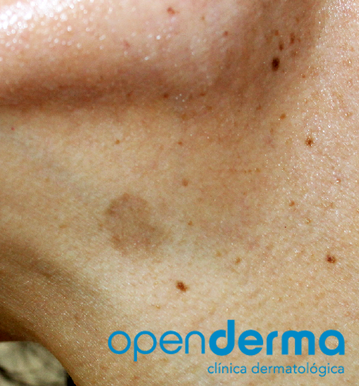 ¿Cómo eliminar las manchas de la piel? 1 mancha openderma murcia