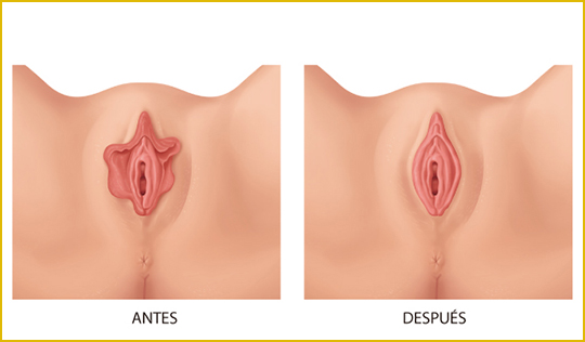 Rejuvenecimiento vaginal Murcia Openderma 19 rejuvenecimiento vaginal