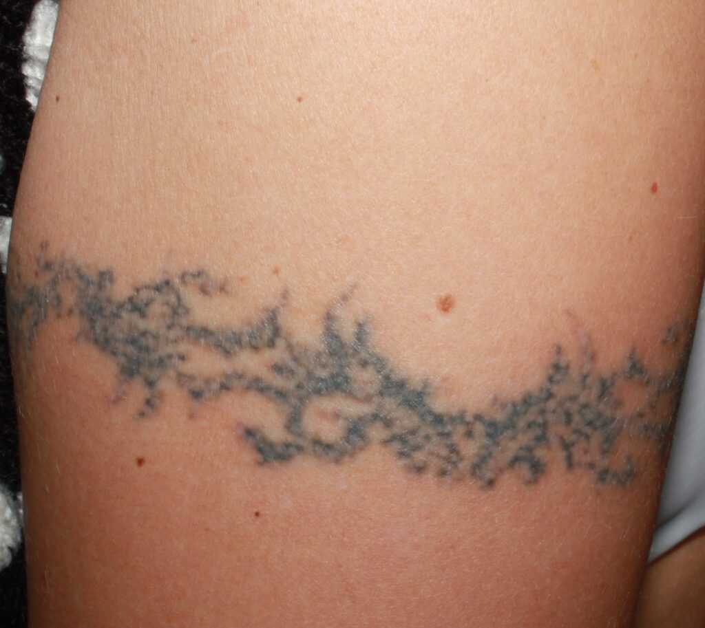 Un tatuaje no es para siempre 1 tatuaje antes
