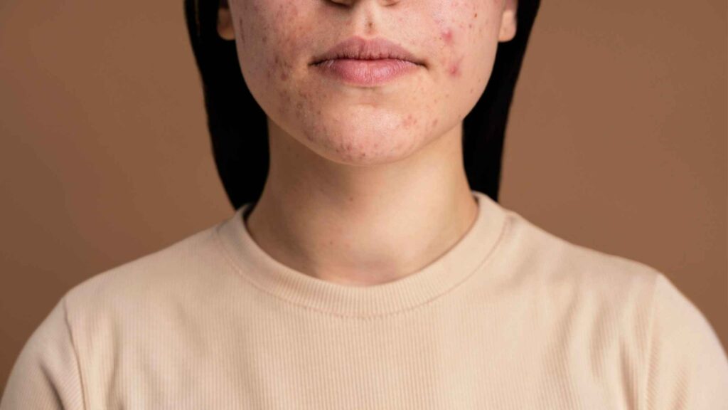 mujer joven con acné inflamatorio en el rostro, tratamiento acné Murcia en Clínica Dermatológica OPENDERMA