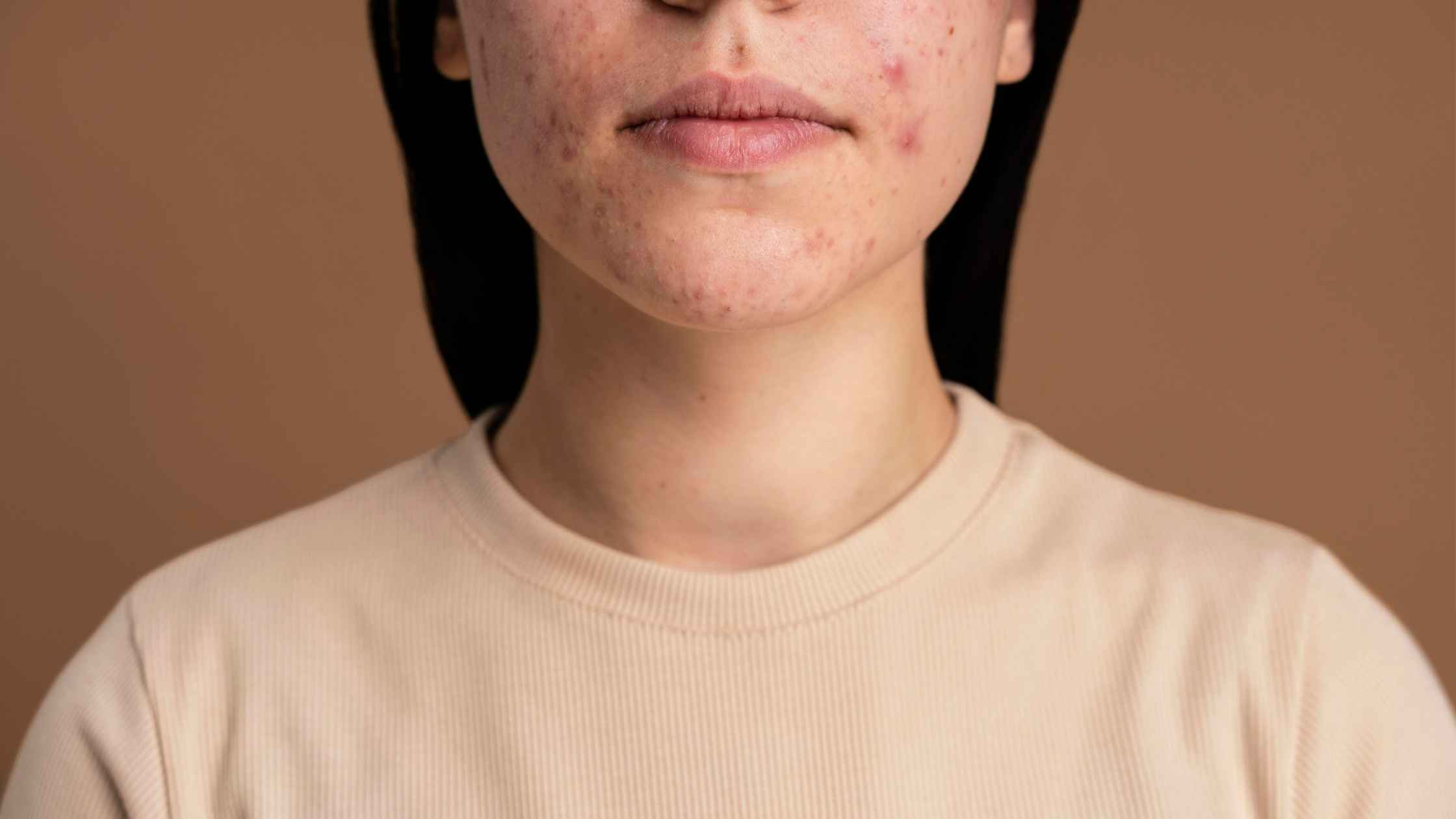 Inicio 4 mujer joven con acné inflamatorio en el rostro, tratamiento acné Murcia en Clínica Dermatológica OPENDERMA