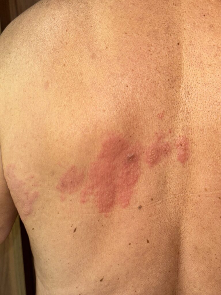Erupción eritematosa y vesiculosa en la parte alta de la espalda siguiendo el trayecto de un dermatoma torácico, compatible con herpes zóster reciente.