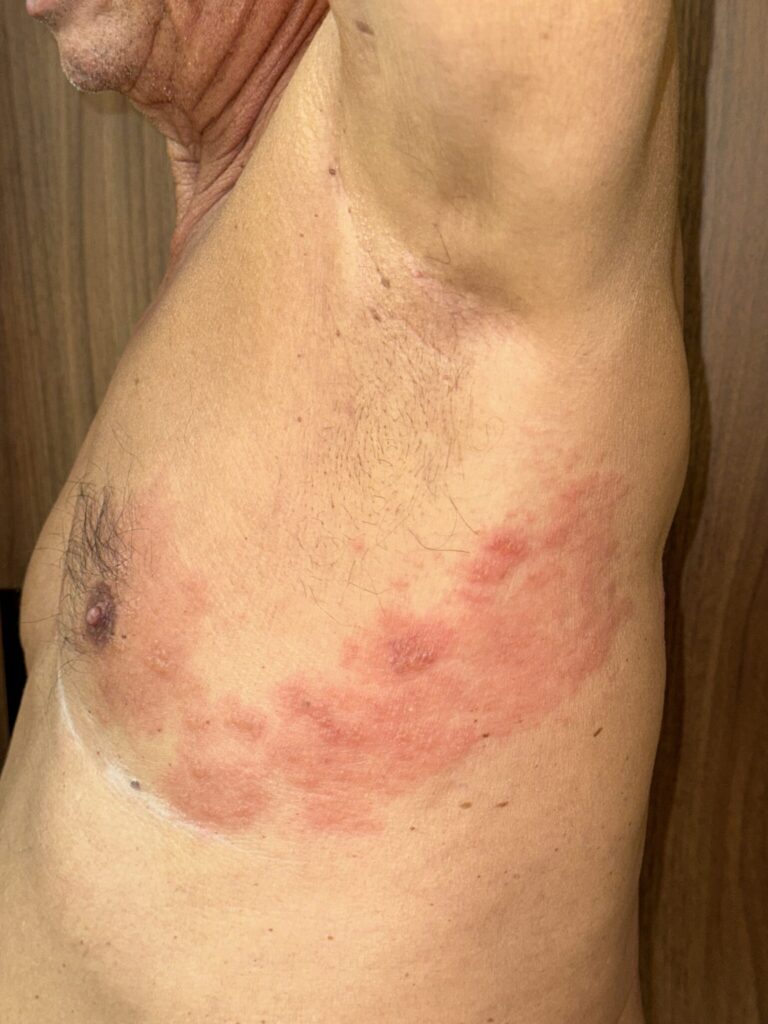 Lesiones eritematosas y vesiculosas agrupadas en distribución dermatómica en el costado y tórax lateral compatibles con herpes zóster en fase inicial.