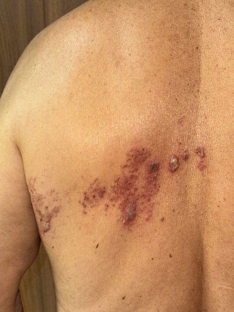 Lesiones cutáneas con vesículas, costras iniciales y áreas de exudado en el costado, siguiendo un dermatoma torácico, compatibles con herpes zóster en fase evolutiva.