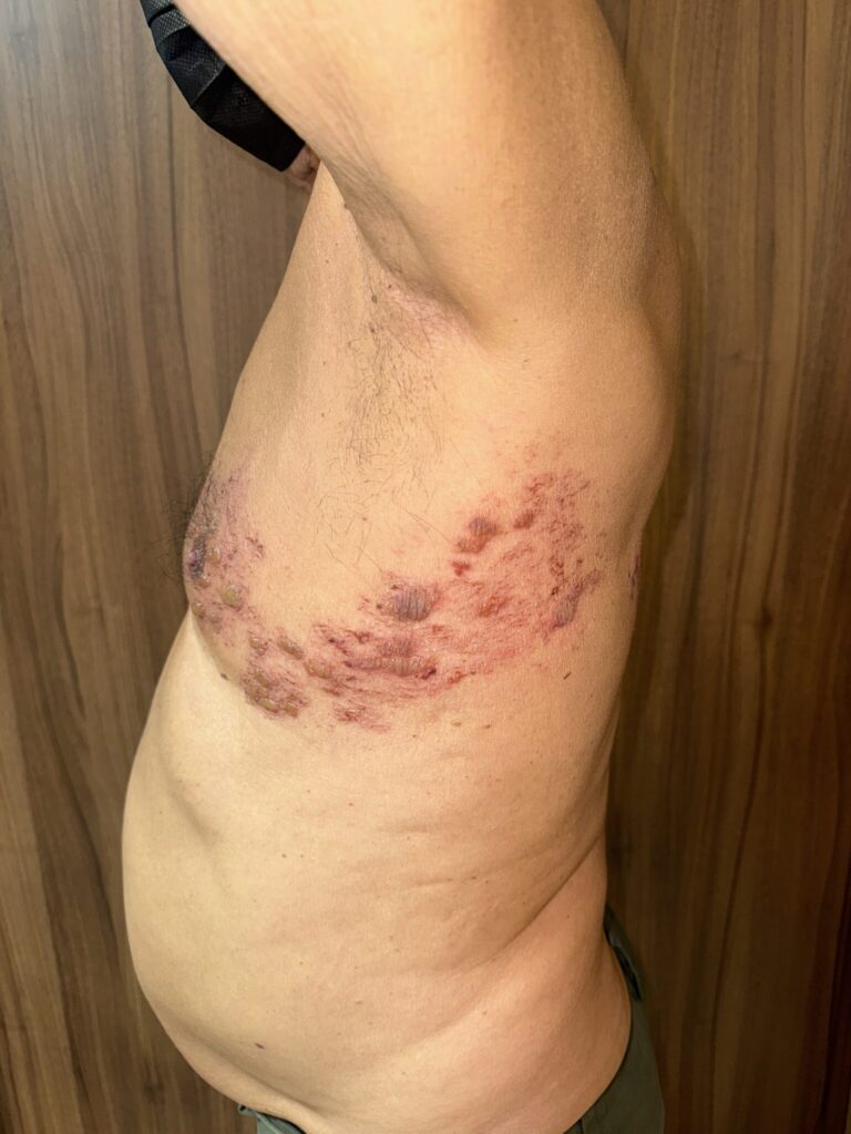 Lesiones eritematosas y vesiculosas evolucionadas con áreas hemorrágicas en la parte alta de la espalda, distribuidas de forma unilateral siguiendo un dermatoma, compatibles con herpes zóster en fase avanzada.