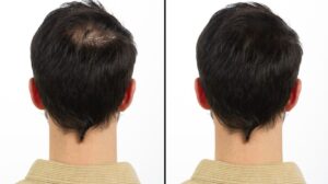 Caída del cabello: qué puede revelar la tricoscopia antes de empezar un tratamiento 2 Alopecia androgenética