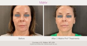 Tratamiento para la flacidez facial y del cuello en Murcia: cómo elegir sin cambiar tus rasgos 2 Antes: «Flacidez facial y del cuello antes del tratamiento con Matrix en Openderma, Murcia». Después: «Rostro y cuello tras el tratamiento con radiofrecuencia Matrix en Openderma, Murcia».