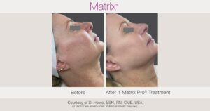 Tratamiento para la flacidez facial y del cuello en Murcia: cómo elegir sin cambiar tus rasgos 1 Antes: «Flacidez facial y del cuello antes del tratamiento con Matrix en Openderma, Murcia». Después: «Rostro y cuello tras el tratamiento con radiofrecuencia Matrix en Openderma, Murcia».