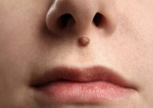 Verrugas en el cuello: por qué no todo lo que parece una verruga lo es 4 Captura de pantalla 2026 10 16 a las 12.40.37