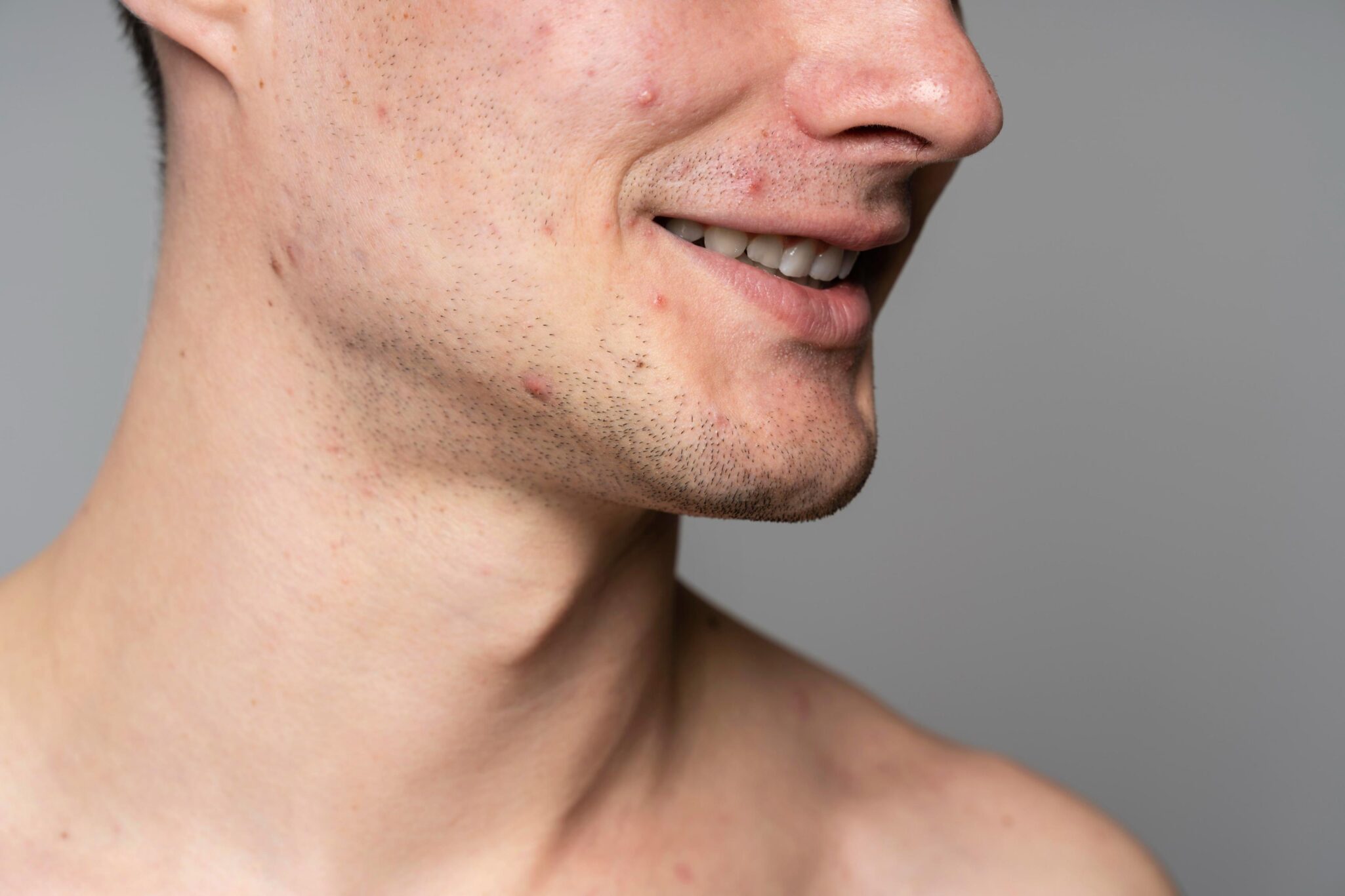 ACNE OPENDERMA DERMATOLOGIA MURCIA 2