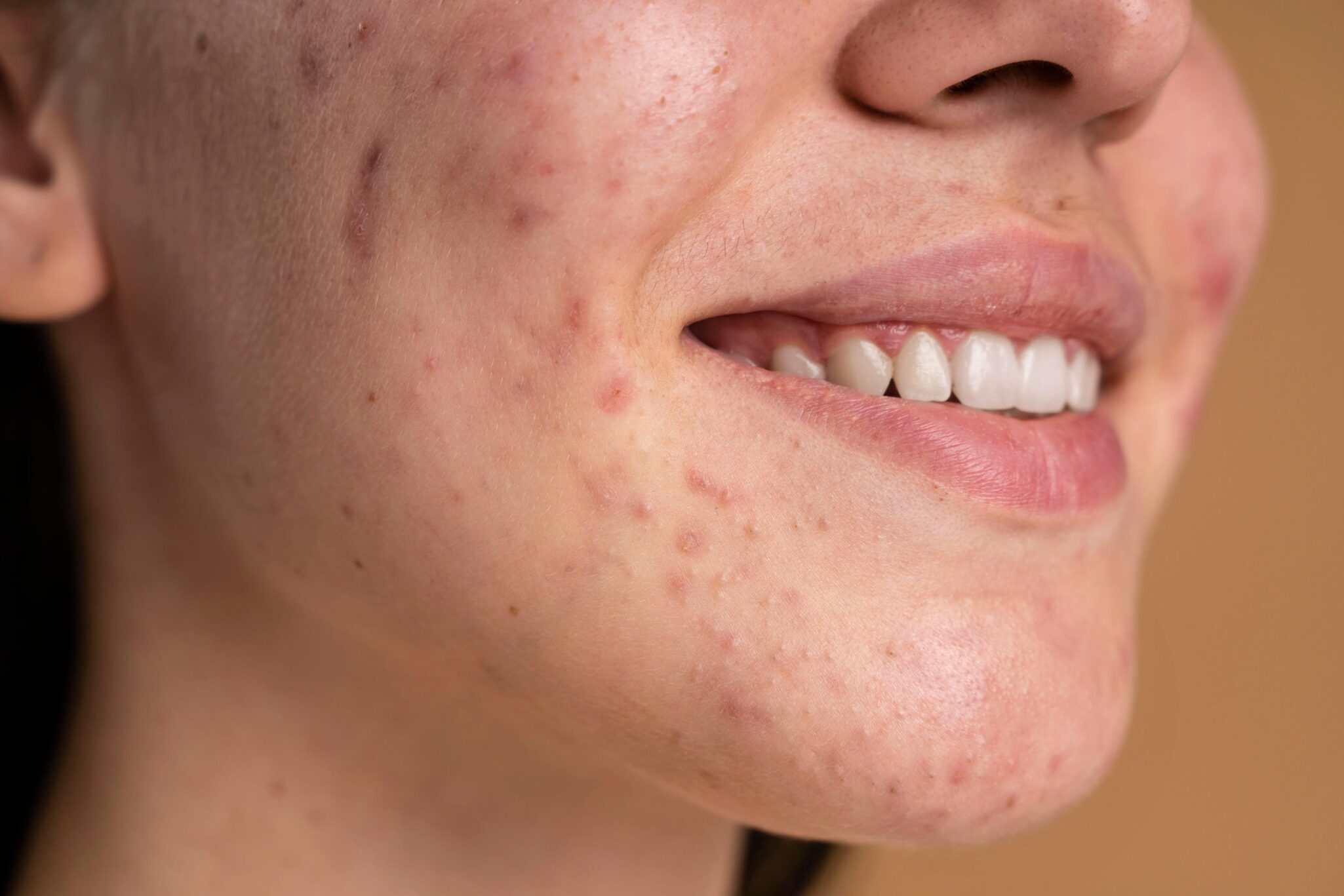ACNE OPENDERMA DERMATOLOGIA MURCIA 3