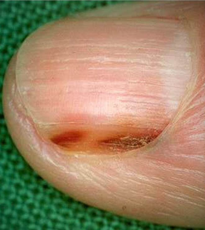 Lo que debes saber en el Día Mundial del Cáncer de Piel 13 Melanoma.Clinica Openderma.Murcia.3