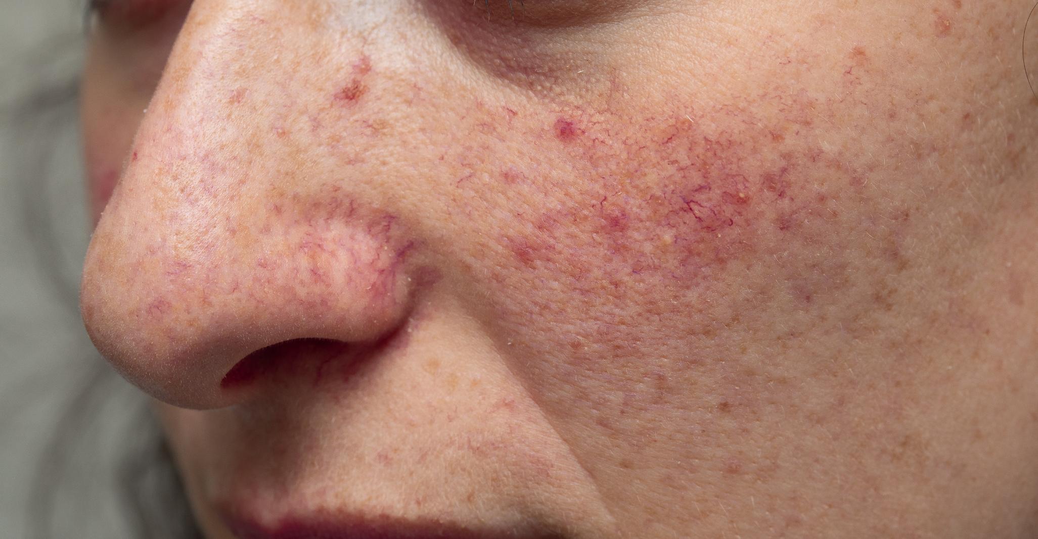 ROSACEA OPENDERMA DERMATOLOGO MURCIA 1