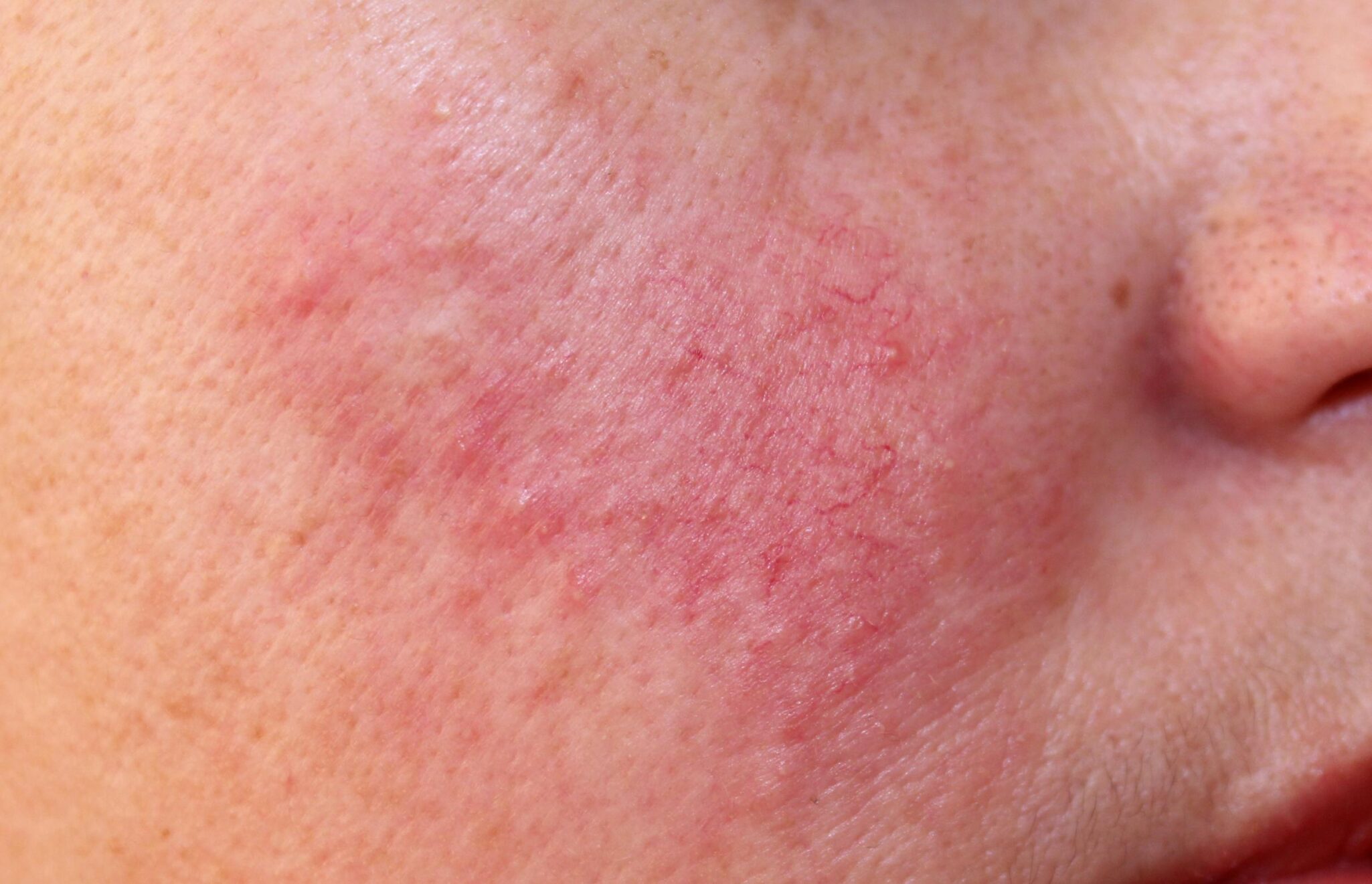 ROSACEA OPENDERMA DERMATOLOGO MURCIA 2