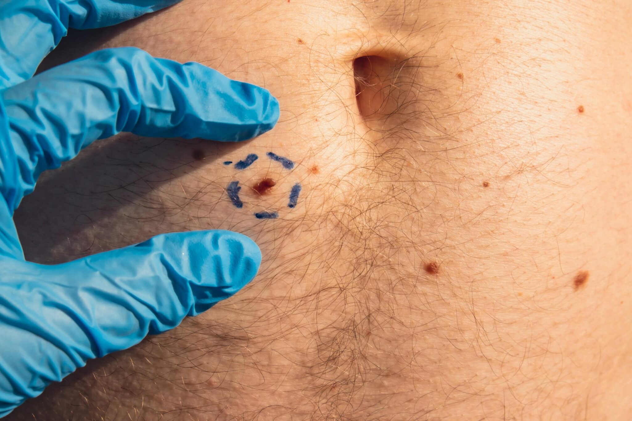 cirugia-lunares-verrugas-openderma (2)