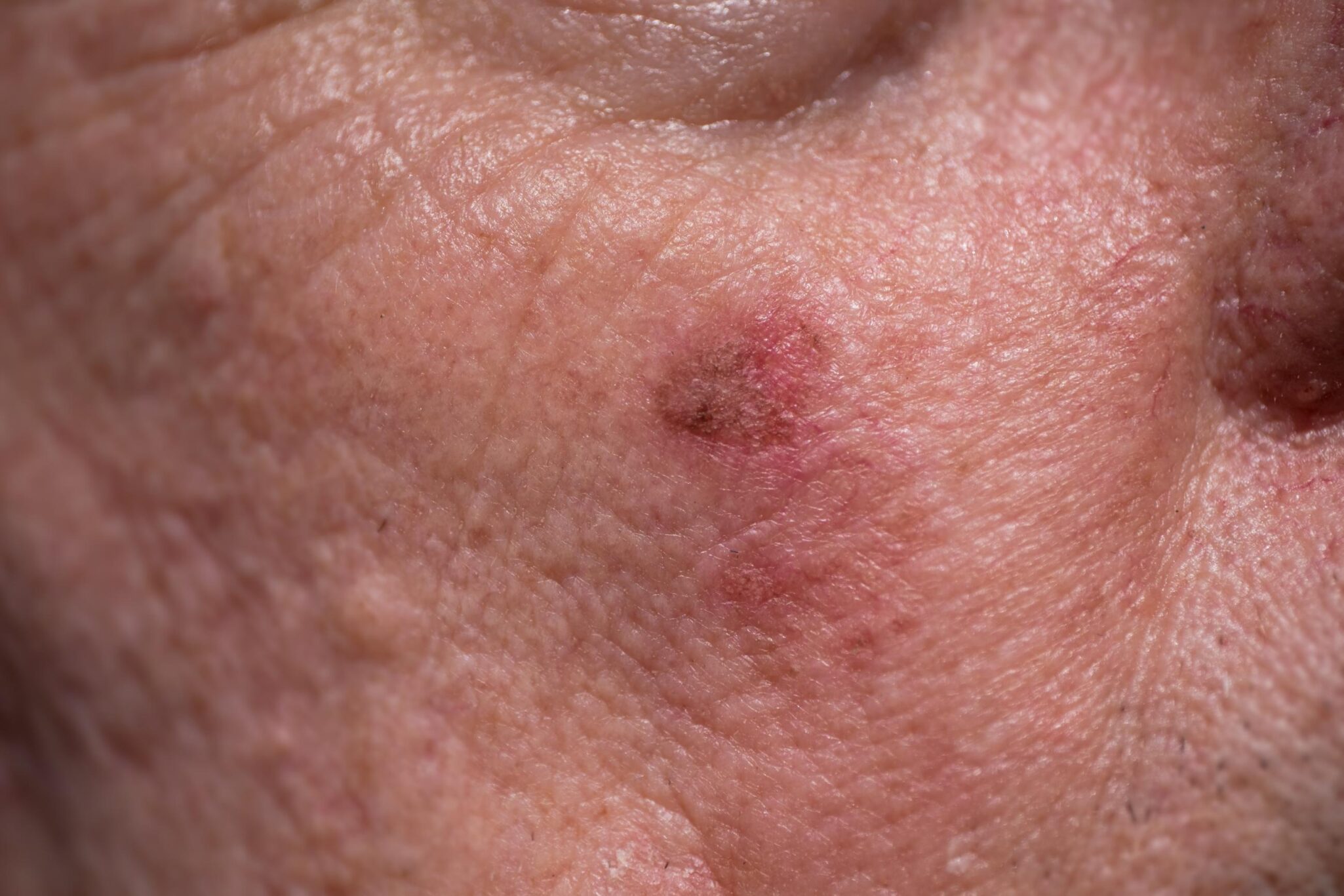 melanoma-openderma-dermatologo-murcia (2)
