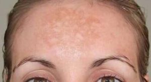 LOS RECUERDOS DEL VERANO EN TU CORAZÓN, NO EN TU PIEL. ¡ADIÓS MANCHAS! 8 melasma 639x350 300x164 1
