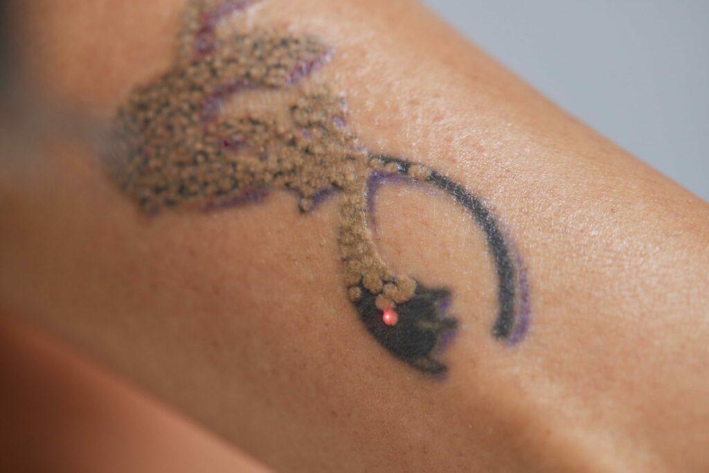 Eliminación de Tatuajes con Láser Picosegundos en Murcia: Guía completa y dudas más frecuentes 7 openderma laser eliminar tatuajes