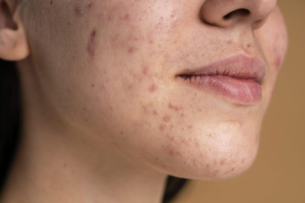 El Acné: Causas, Prevención y Tratamientos Especializados 9 tratamiento acne murcia