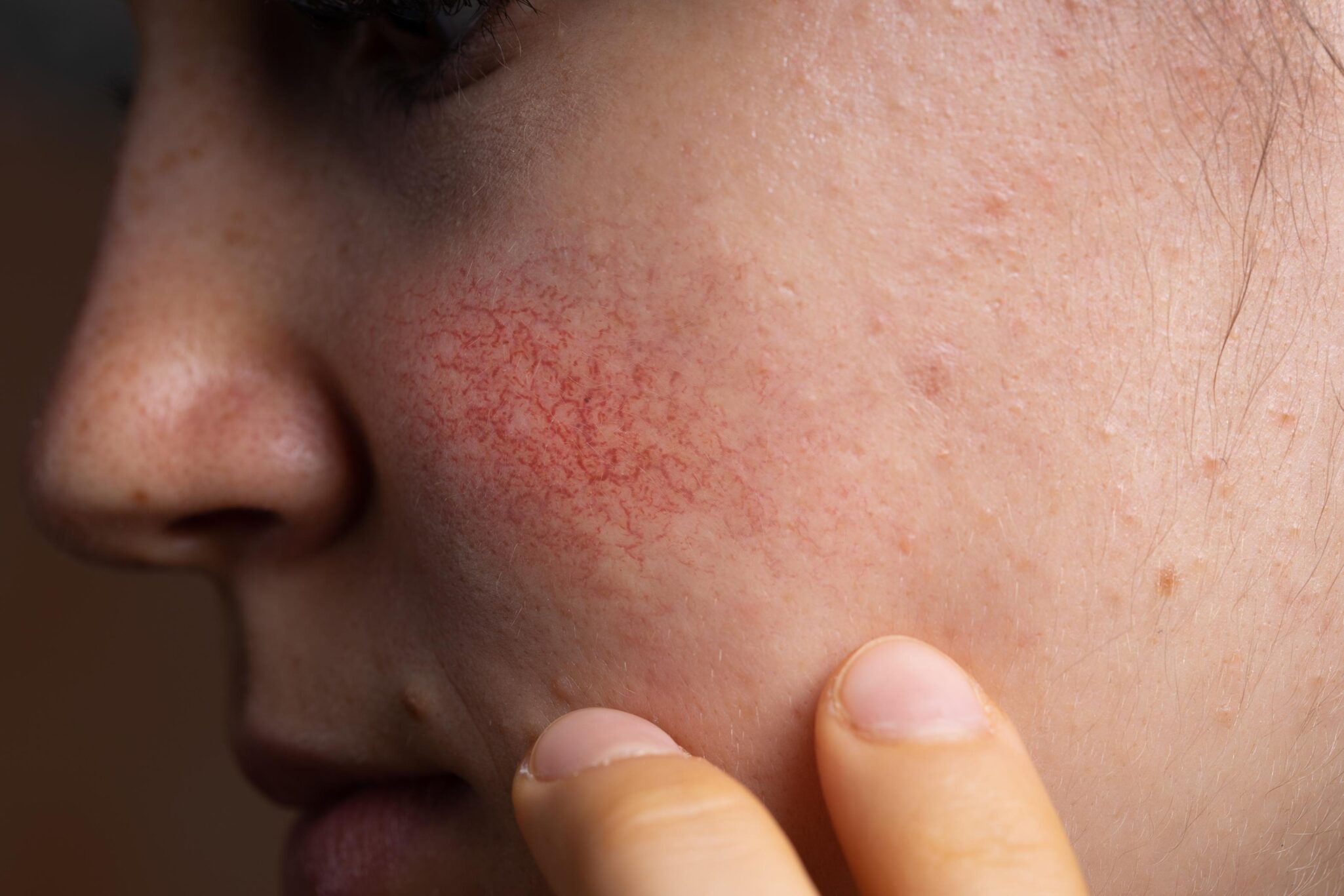 angioma-openderma-dermatologo-murcia (2)