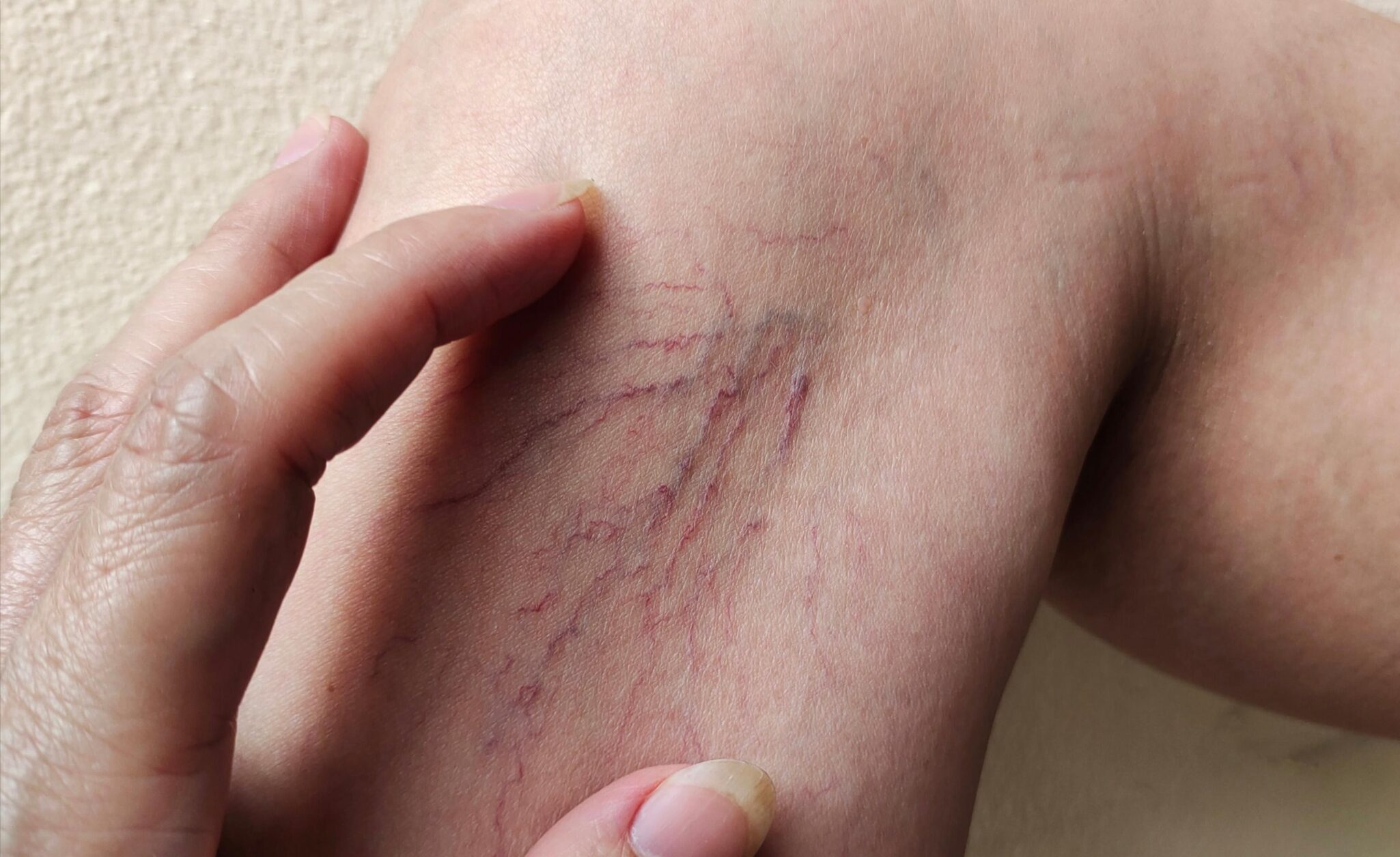 angioma-openderma-dermatologo-murcia (3)
