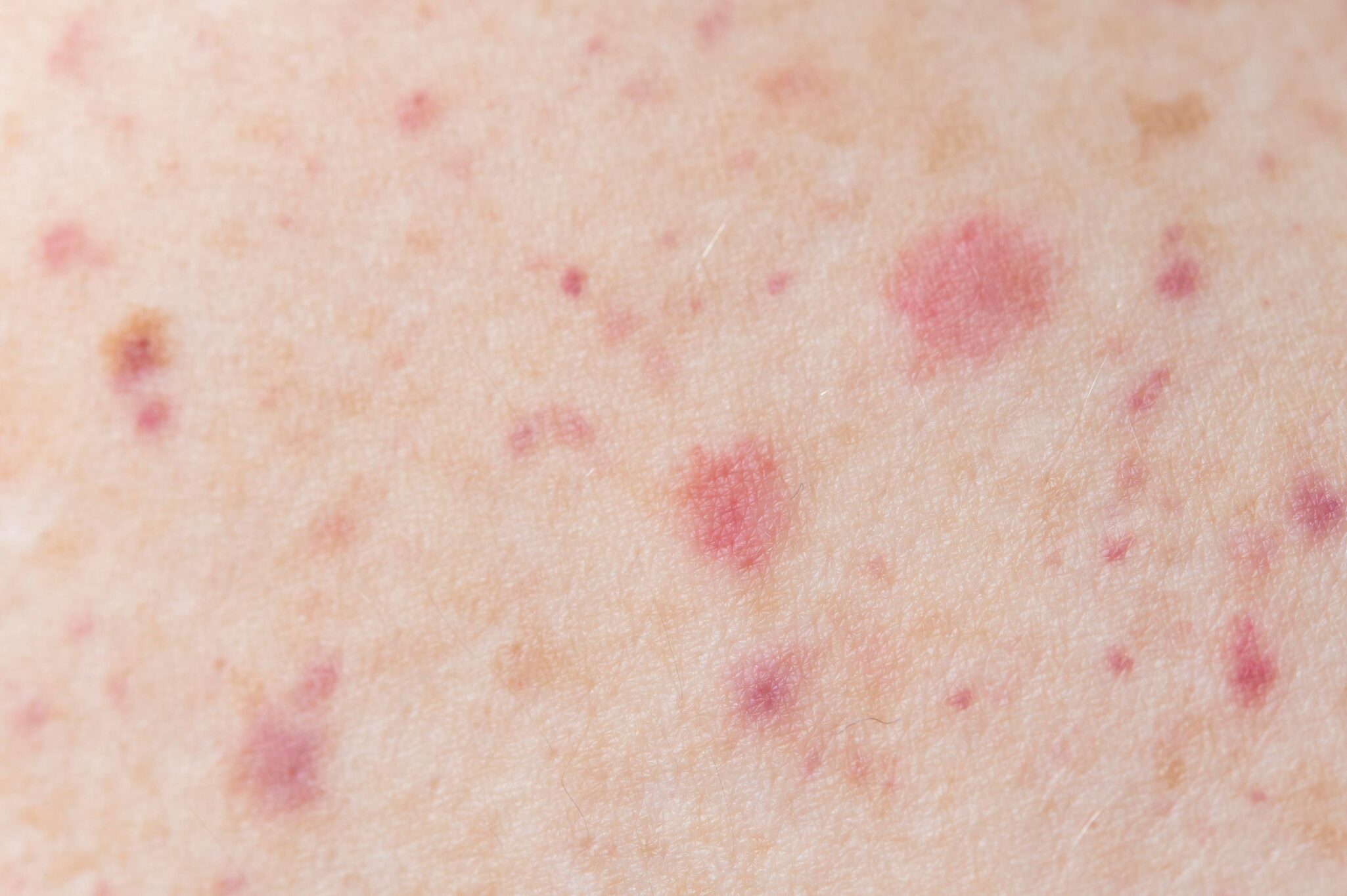 micosis-openderma-dermatologo-murcia (2)
