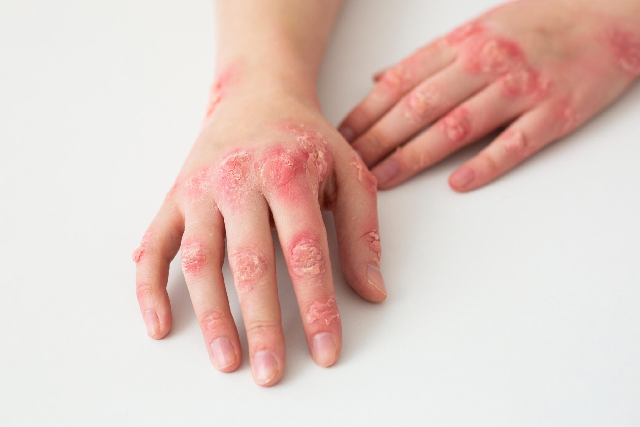 micosis-openderma-dermatologo-murcia (3)