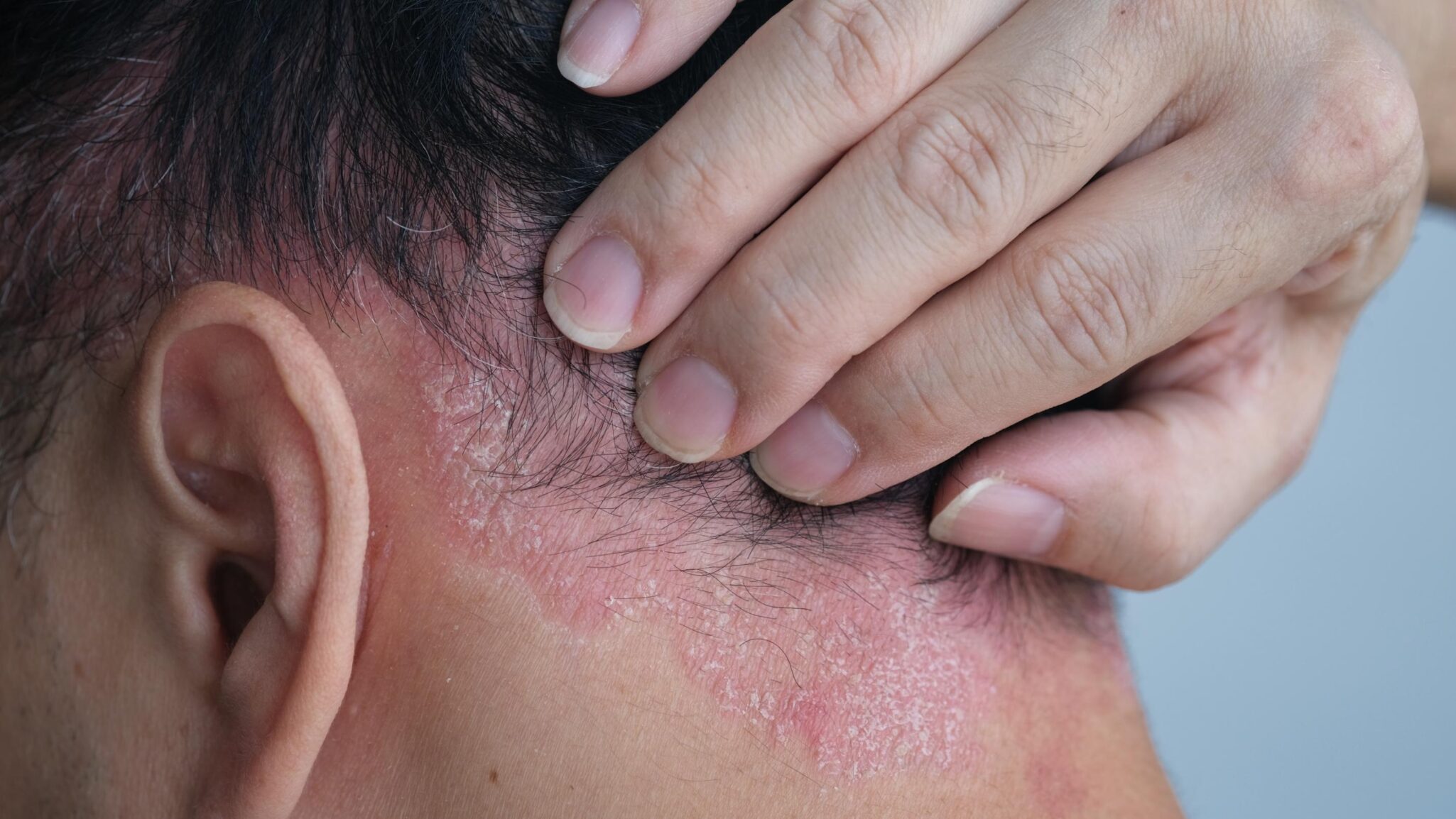 psoriasis-openderma-dermatologo-murcia (2)