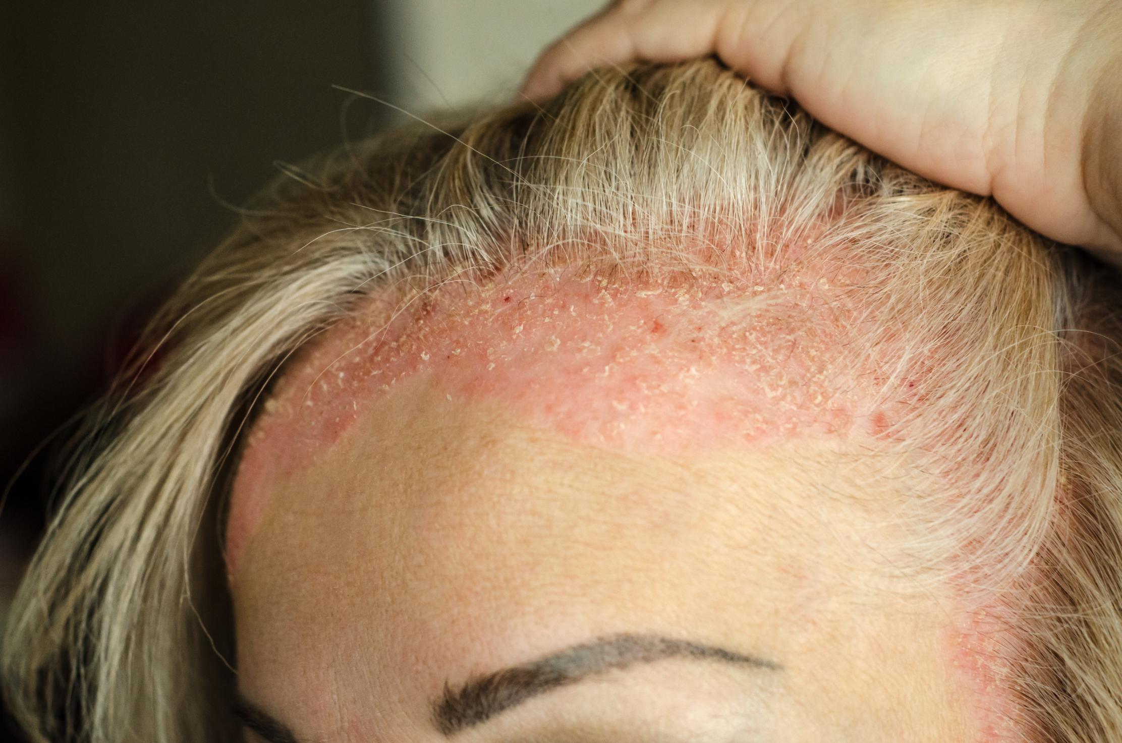 psoriasis-openderma-dermatologo-murcia (3)