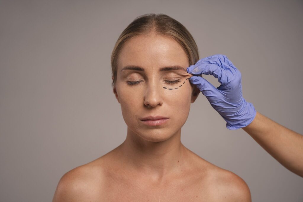 Primer plano del contorno ocular de una paciente antes de la blefaroplastia sin cirugía