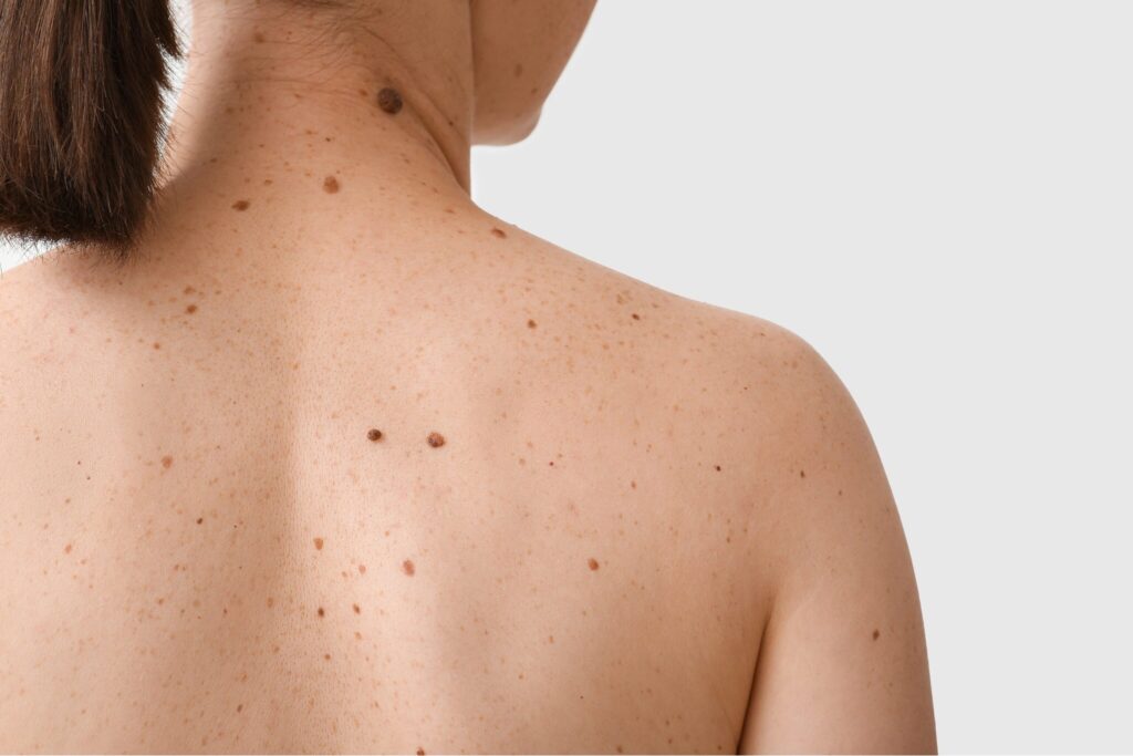 ¿Cómo prevenir el cáncer de piel? Guía completa desde la dermatología 1 dermatologia-cancerdepiel-lunares