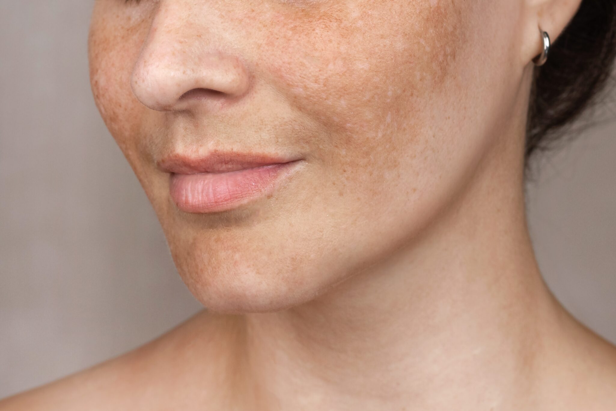 Manchas faciales tras el verano tratadas en Clínica Dermatológica OPENDERMA Murcia