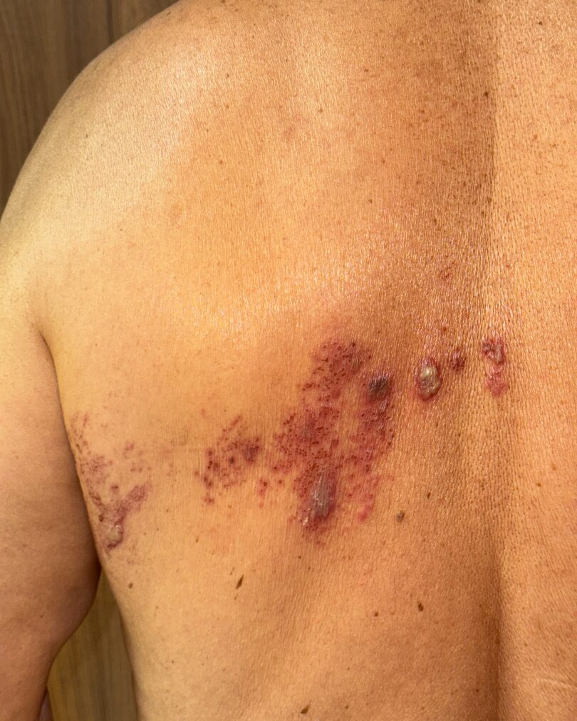 Clínica OPENDERMA | Herpes Zoster en tratamiento 2