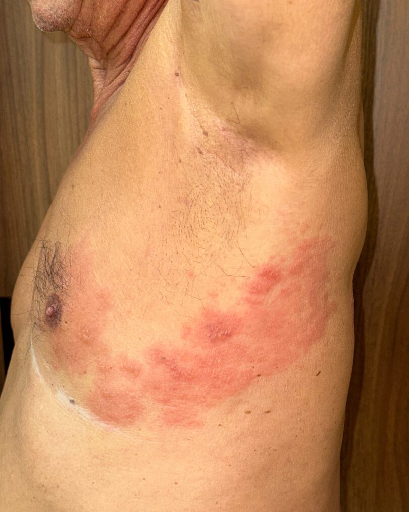 Clínica OPENDERMA | Herpes Zoster en estado inicial 1