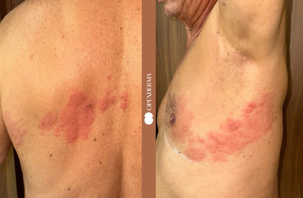 Composición de cuatro imágenes que muestran la evolución del herpes zóster en un dermatoma torácico, desde el eritema inicial hasta la aparición de vesículas tensas y costras