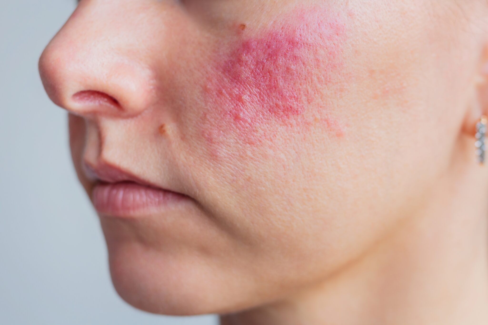 Young,Caucasian,Woman,Suffering,From,Rosacea,On,Her,Face,In