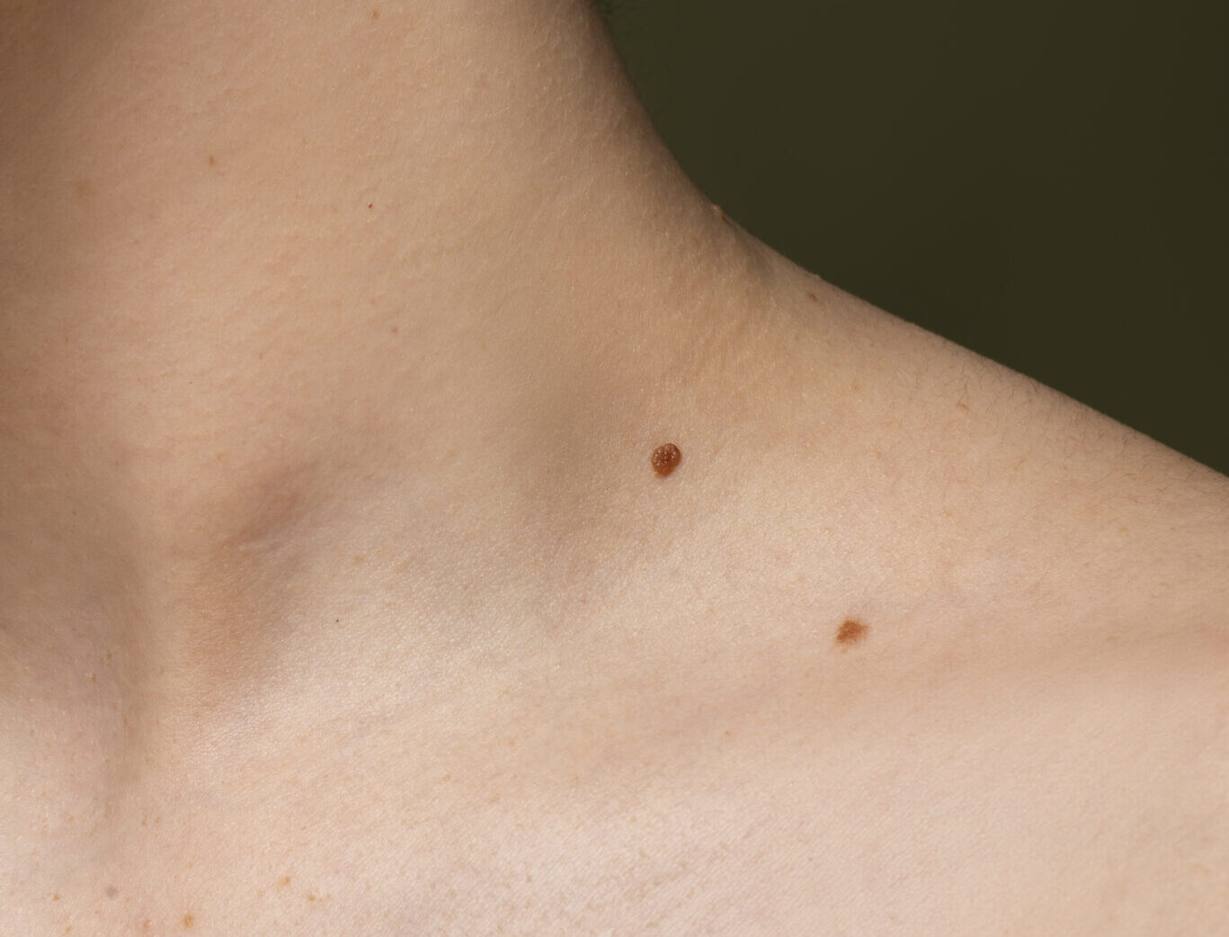 Inicio 6 side view skin texture with moles e1792232554379