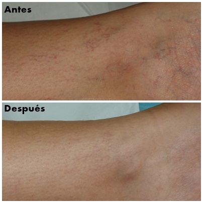 Clínica Dermatológica Openderma Murcia láser vascular, varices y arañas