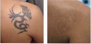 Laser de picosegundos tatuajes