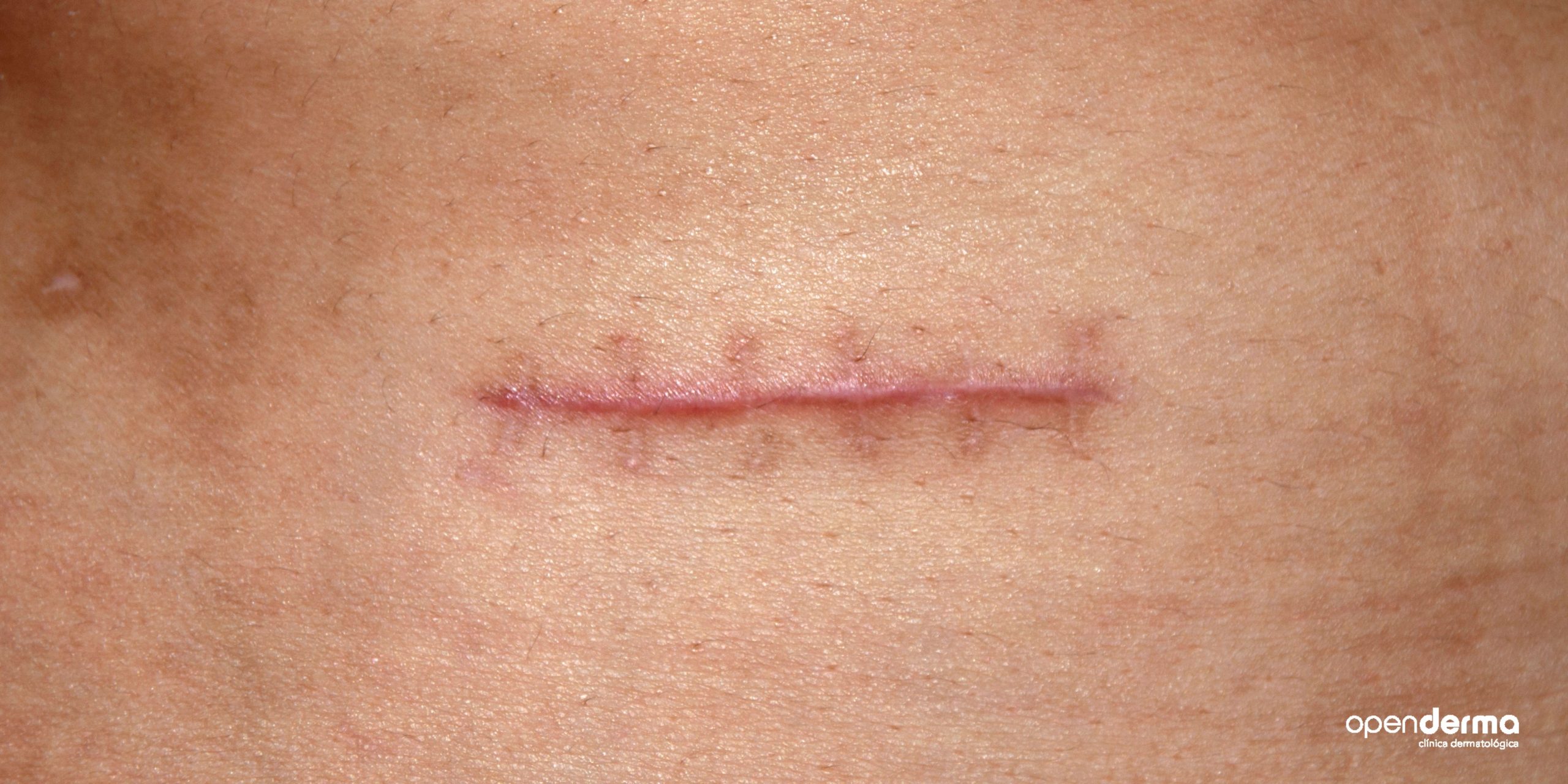 cicatriz quirurgica